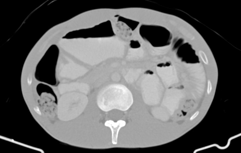 Blunt injury to the small bowel (Radiopaedia 74953-85987 Axial Wide 35).jpg