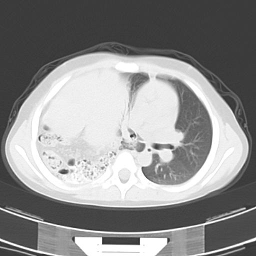 File:Bochdalek diaphragmatic hernia (Radiopaedia 38866-41059 Axial lung window 11).jpg