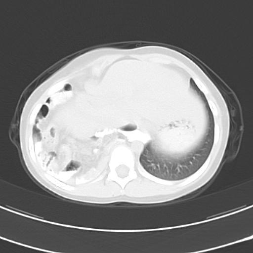 File:Bochdalek diaphragmatic hernia (Radiopaedia 38866-41059 Axial lung window 21).jpg