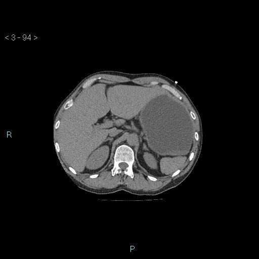 Boerhaave syndrome (Radiopaedia 27683-27897 Axial non-contrast 94).jpg