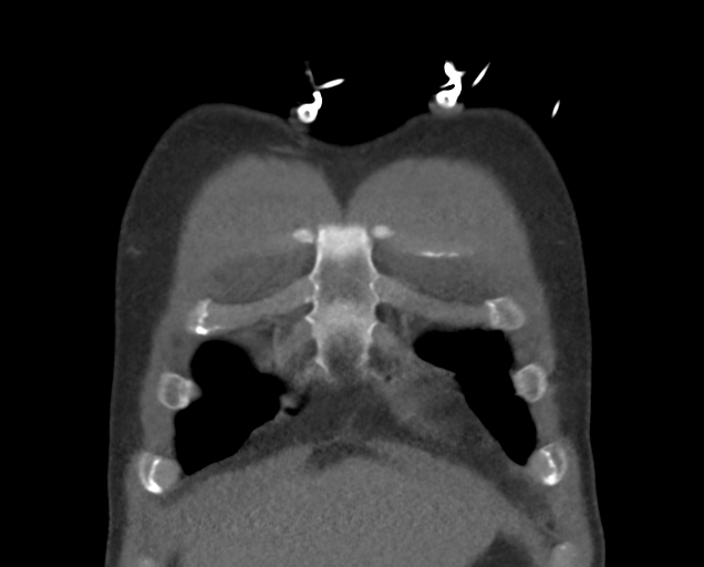 Boerhaave syndrome (Radiopaedia 39382-41660 C 14).png