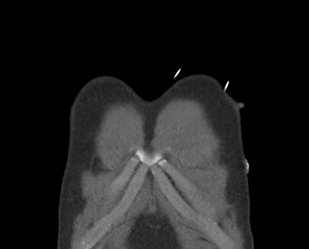 File:Boerhaave syndrome (Radiopaedia 39382-41660 C 9).png