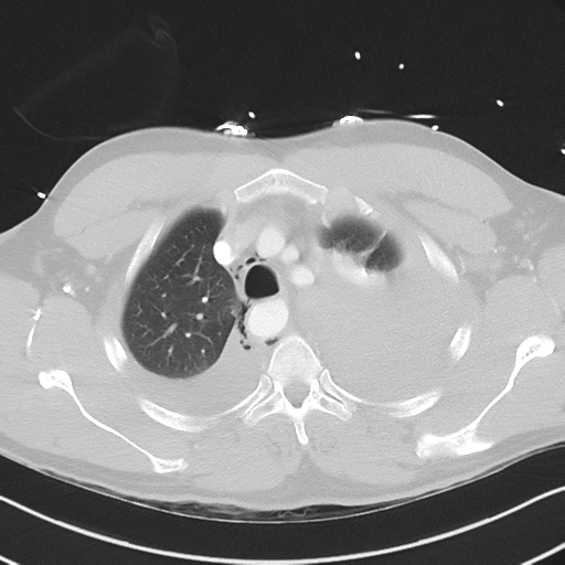 Boerhaave syndrome (Radiopaedia 39382-41661 Axial lung window 13).png