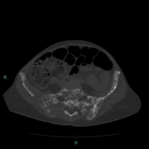 Bone metastases from untreated breast cancer (Radiopaedia 42973-46219 Axial bone window 148).jpg