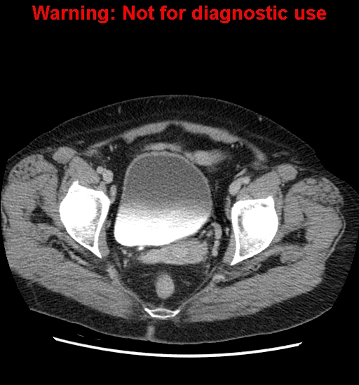 File:Bosniak renal cyst - type II (Radiopaedia 23404-23468 F 61).jpg