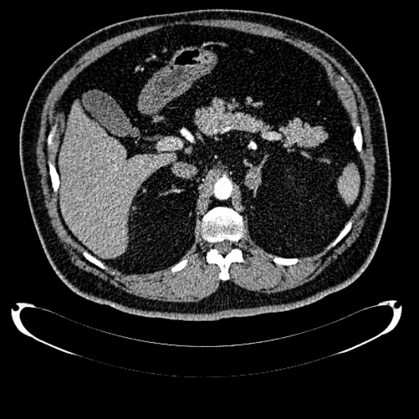 Bosniak renal cyst - type IV (Radiopaedia 24244-24518 B 95).jpg