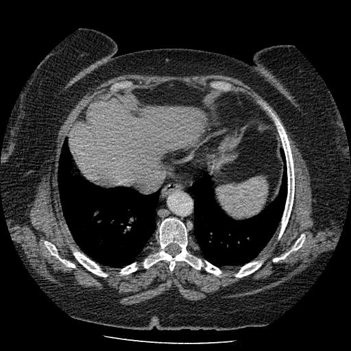 Bovine aortic arch - right internal mammary vein drains into the superior vena cava (Radiopaedia 63296-71875 A 121).jpg