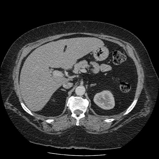 Bovine aortic arch - right internal mammary vein drains into the superior vena cava (Radiopaedia 63296-71875 A 189).jpg