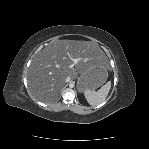Bowel and splenic infarcts in acute lymphocytic leukemia (Radiopaedia 61055-68915 A 38).jpg