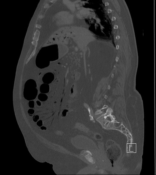 File:Bowel ischemia secondary to SMA occlusion with extensive portomesenteric venous gas (Radiopaedia 54656-60871 Sagittal bone window 62).jpg