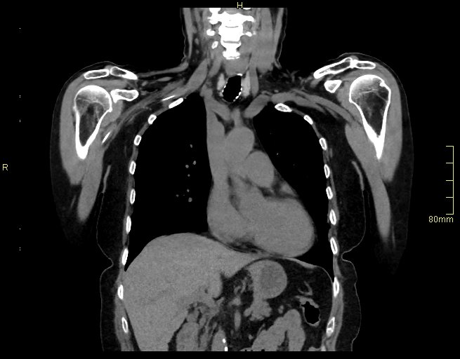 Brachial artery foreign body (Radiopaedia 54583-60820 Coronal non-contrast 23).jpg