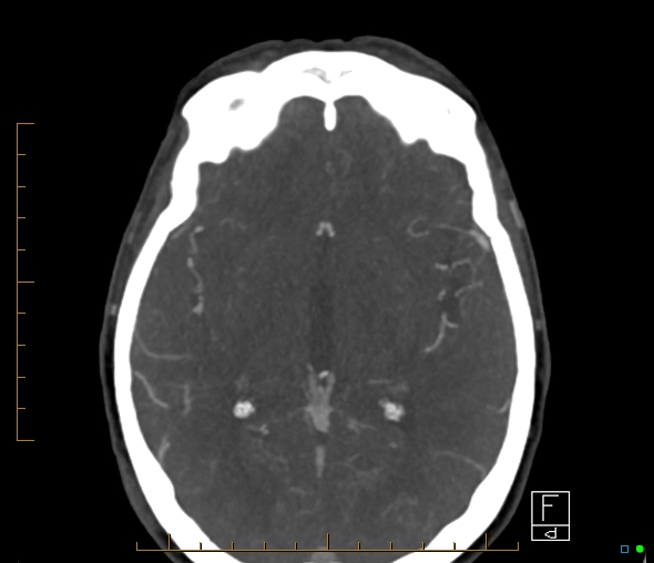 Brachiocephalic trunk stenosis (Radiopaedia 87242-103519 A 35).jpg