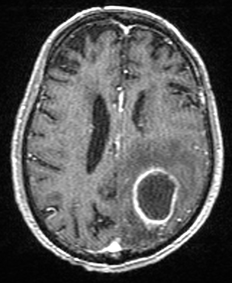 Brain abscess with dual rim sign (Radiopaedia 87566-103938 Axial T1 C+ 107).jpg