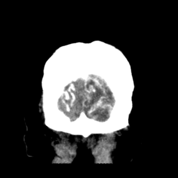 Brain cortical laminar necrosis (Radiopaedia 25822-25971 C 52).jpg