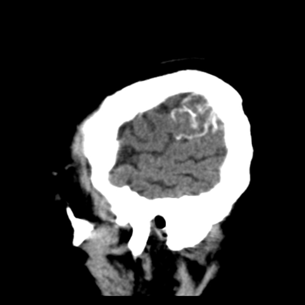 Brain cortical laminar necrosis (Radiopaedia 25822-25971 non-contrast 44).jpg