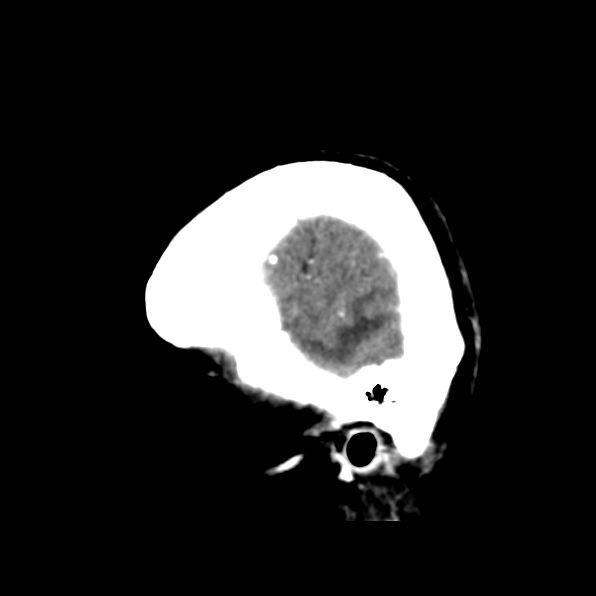 File:Brain metastases from breast cancer (Radiopaedia 23178-23231 C 6).jpg