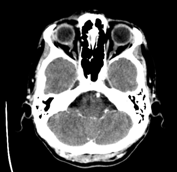 File:Brain metastases from lung cancer (Radiopaedia 24480-24781 Axial C+ delayed 10).jpg