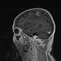 Brain metastasis (Radiopaedia 42617-45761 Sagittal T1 C+ 28).jpg