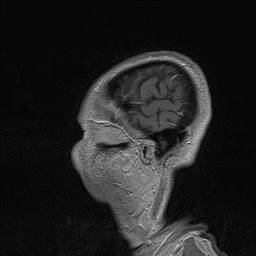 Brain metastasis (Radiopaedia 42617-45761 Sagittal T1 C+ 89).jpg