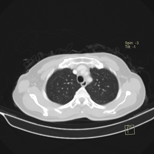 Brain metastasis as initial presentation of non-small cell lung cancer (Radiopaedia 65122-74127 Axial lung window 12).jpg