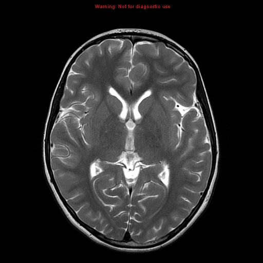 File:Brainstem glioma (Radiopaedia 9444-10124 Axial T2 11).jpg