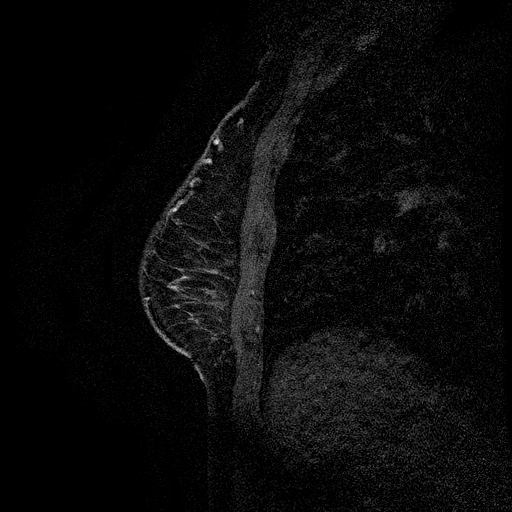 File:Breast lipoma and cancer (Radiopaedia 15118-14995 D 5).jpg