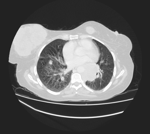 Breast metastases from facial malignant melanoma (Radiopaedia 60316-67975 Axial lung window 61).jpg