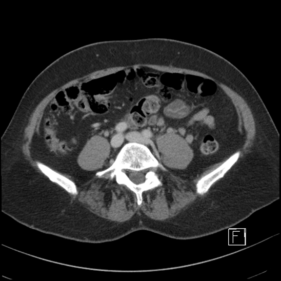 File:Breast metastases from renal cell cancer (Radiopaedia 79220-92225 C 72).jpg