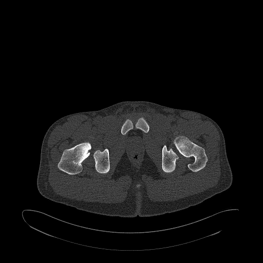 Brodie abscess- femoral neck (Radiopaedia 53862-59966 Axial bone window 178).jpg
