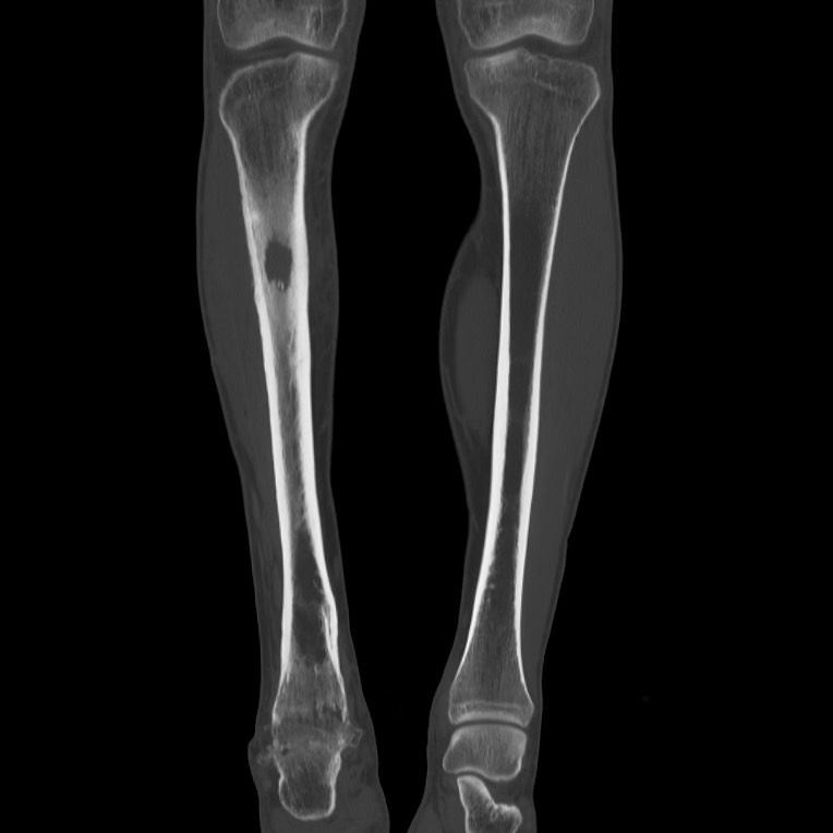 Brodie abscess - tibia (Radiopaedia 66028-75204 Coronal bone window 18).jpg