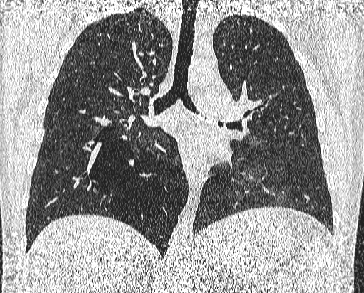 Bronchial atresia (Radiopaedia 58271-65417 Coronal lung window 31).jpg