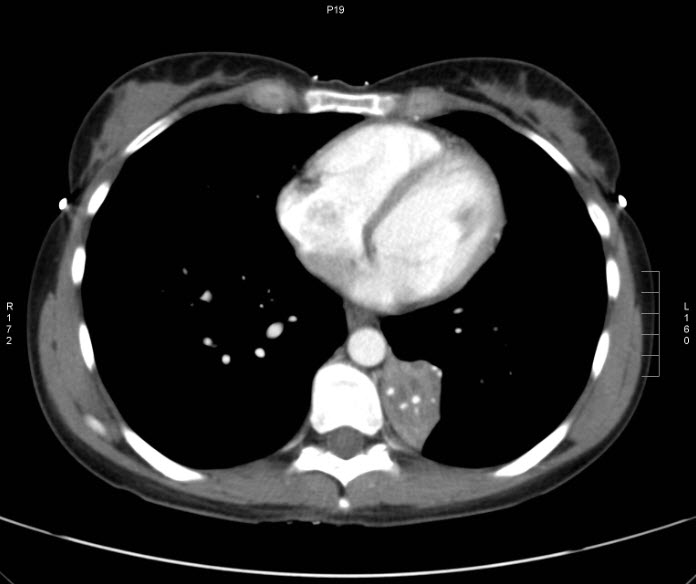 File:Bronchial carcinoid tumor (Radiopaedia 15042-42507 B 9).jpg