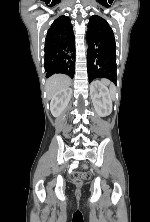 Bronchial carcinoid tumor (Radiopaedia 57187-64090 B 90).jpg