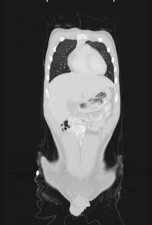 Bronchial carcinoid tumor (Radiopaedia 57187-64090 Coronal lung window 14).jpg