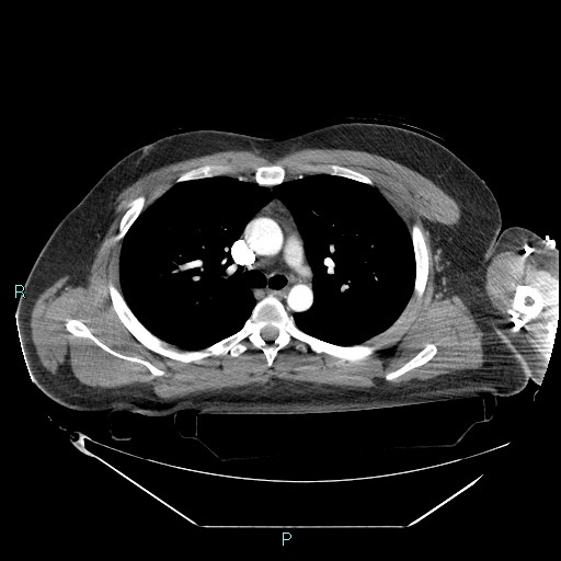 Bronchial carcinoid tumor (Radiopaedia 78272-90870 B 48).jpg