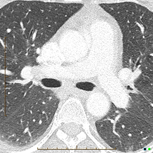 File:Bronchial diverticula (Radiopaedia 79512-92677 Axial lung window 9).jpg