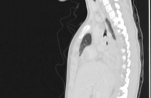 File:Bronchial mucoepidermoid carcinoma (Radiopaedia 57023-63895 Sagittal lung window 60).jpg