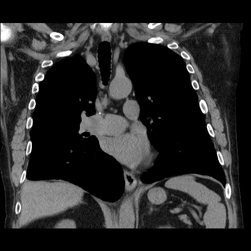 Bronchial stenosis - lung transplant (Radiopaedia 73133-83848 Coronal non-contrast 36).jpg