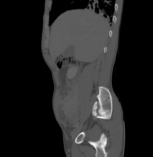 Bronchiectasis in Crohn disease (Radiopaedia 60311-67977 Sagittal bone window 56).jpg