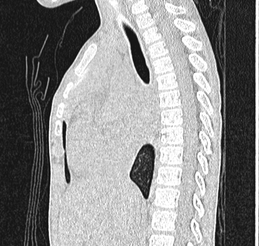 Bronchiolitis obliterans (Radiopaedia 71538-81897 Sagittal lung window 32).jpg