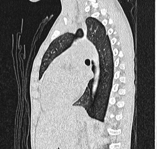 Bronchiolitis obliterans (Radiopaedia 71538-81897 Sagittal lung window 41).jpg