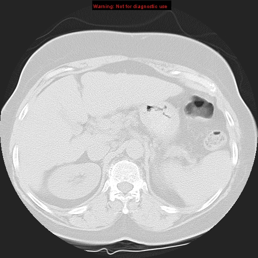 Bronchoalveolar carcinoma (Radiopaedia 13224-13233 Axial lung window 50).jpg