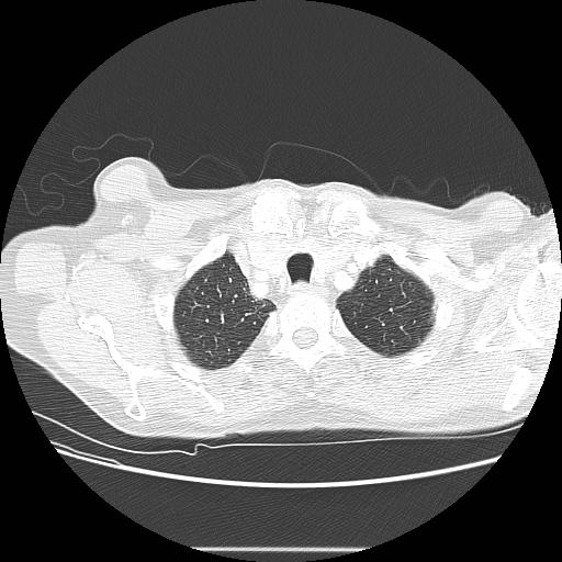 Bronchocele (Radiopaedia 17097-16795 Axial lung window 16).jpg