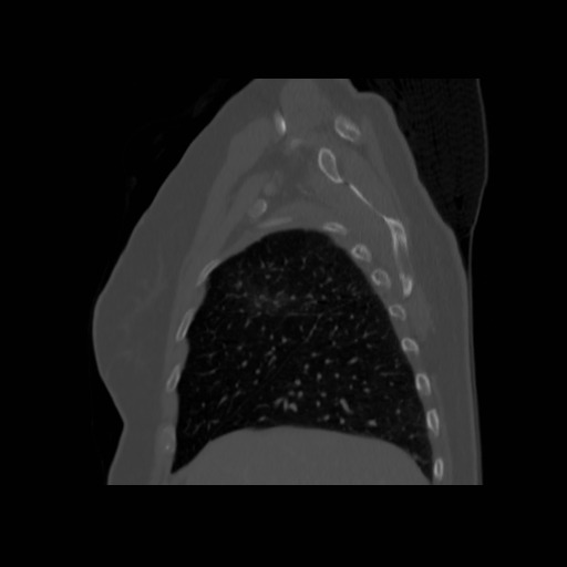 Bronchogenic carcinoma (Radiopaedia 73497-84262 Sagittal bone window 41).jpg