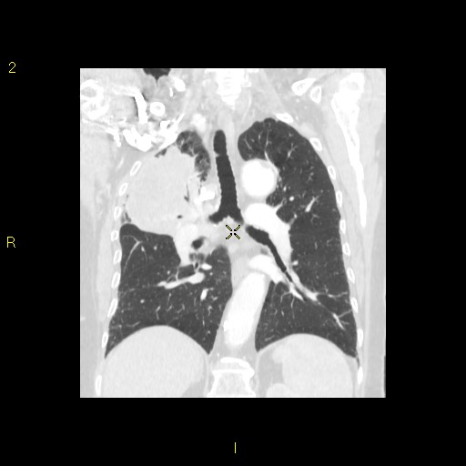 File:Bronchogenic carcinoma as an incidental finding (Radiopaedia 16453-16130 Coronal lung window 31).jpg