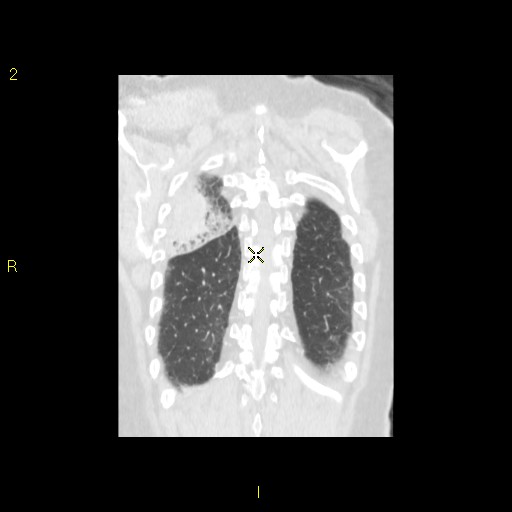 File:Bronchogenic carcinoma as an incidental finding (Radiopaedia 16453-16130 Coronal lung window 41).jpg