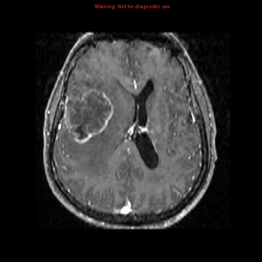 File:Bronchogenic carcinoma brain metastasis (Radiopaedia 9286-9969 Axial T1 C+ 9).jpg