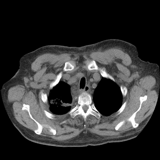 Bronchogenic carcinoma with metastatic lymphadenopathy (Radiopaedia 37671-39569 Axial non-contrast 9).jpg