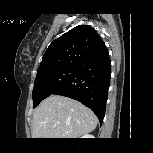 Bronchogenic cyst - posterior mediastinal (Radiopaedia 43885-47364 B 27).jpg