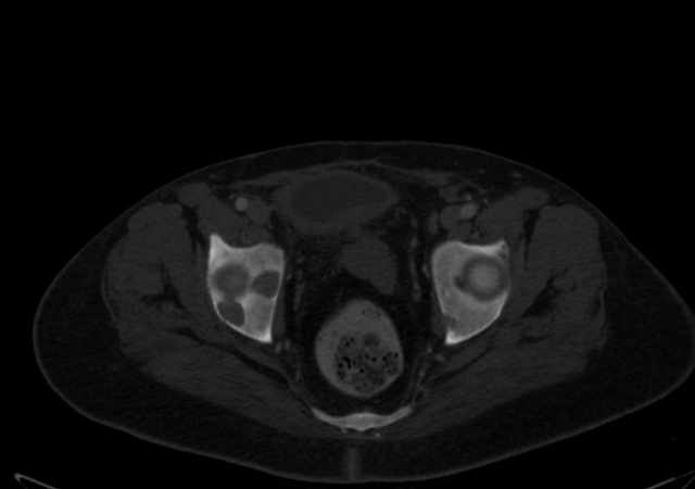 Brown tumors compressing the spinal cord (Radiopaedia 68442-77988 G 115).jpg